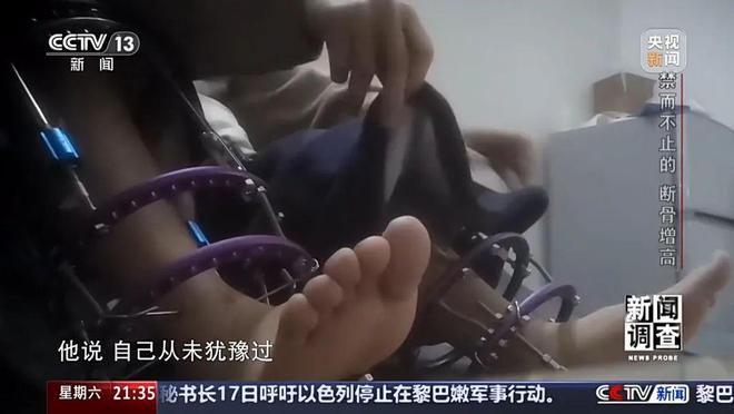 光明日报：澳门正版免费资料2024年-“腿喷脓了，挤也挤不完”，女子出国做手术断骨增高6厘米，右腿严重感染