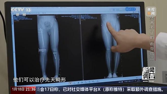 光明日报：澳门正版免费资料2024年-“腿喷脓了，挤也挤不完”，女子出国做手术断骨增高6厘米，右腿严重感染