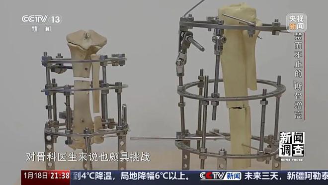 光明日报：澳门正版免费资料2024年-“腿喷脓了，挤也挤不完”，女子出国做手术断骨增高6厘米，右腿严重感染